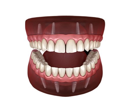 Top Quality Dental Implants in Hollywod FL