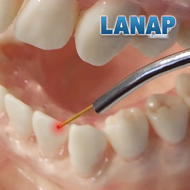 Illustration of a thin LANAP® laser fiber placed at the gumline of a lower tooth
