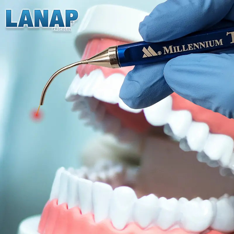 Illustration of the LANAP® laser handpiece