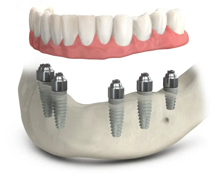 Illustration of a full-arch set of teeth attached to dental implants in the lower jaw