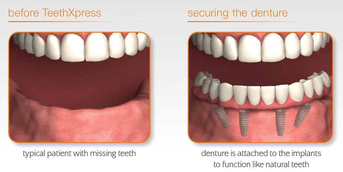 Illustration: a lower jaw with missing teeth, then a full-arch denture secured to four implants