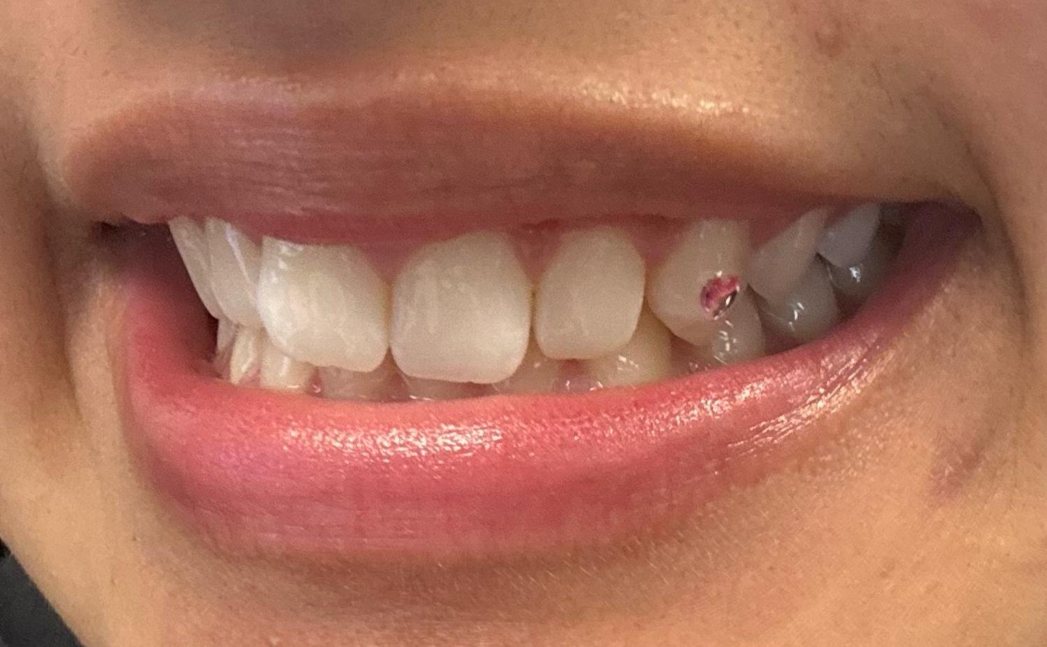 Smile with a pink tooth gem on an upper side tooth