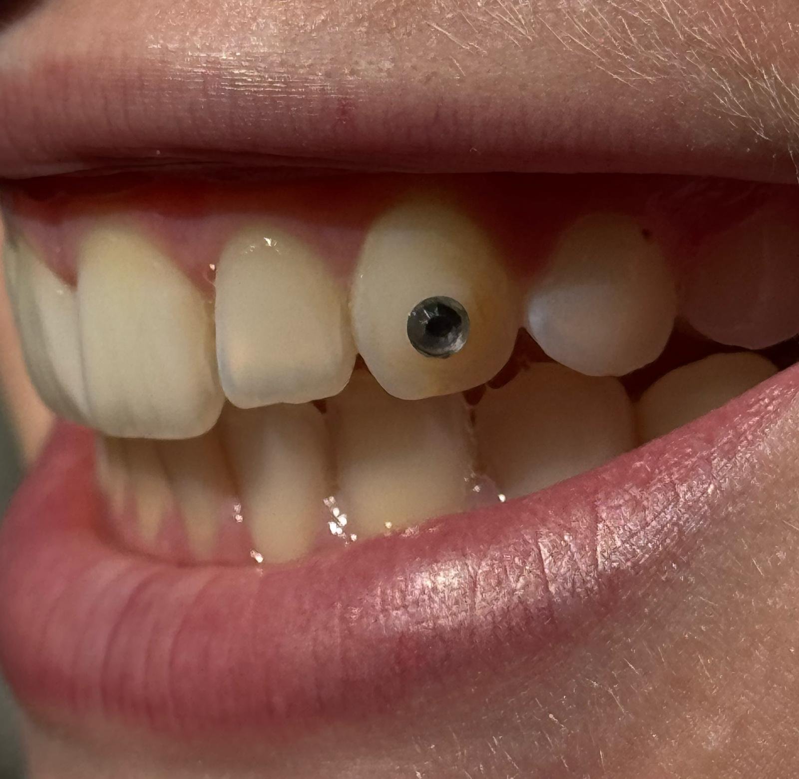 Close-up of a smile with a tooth gem bonded to an upper front tooth